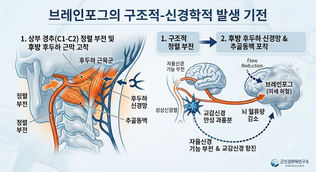 상부 경추 정렬 부전과 후두하 신경망 및 추골동맥 포착으로 일어나는 브레인포그 발생 기전 인포그래픽