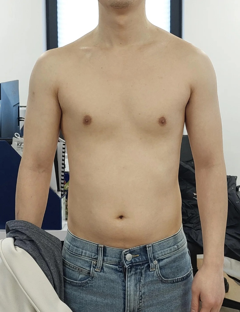 A frontal photograph showing the upper body of a male patient for posture analysis, as referenced in image_153.png. The image captures the natural alignment and muscular balance of the chest and abdomen. The patient is shirtless, and wearing blue jeans. The background is a clinical environment, with indistinct medical files and equipment visible. The lighting is neutral, clearly showing physical details without distortion. This is a real-life clinical data point used to analyze the structural causes of calf tightness, such as swayback or pelvic imbalance.