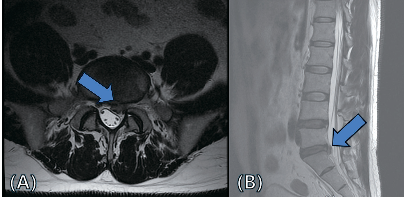 Figure 1. 요추 MRI: L5/S1 추간판 탈출 소견 (논문 원본)